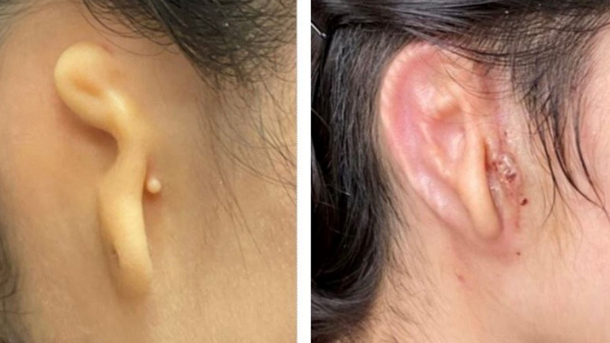 Transplant de ureche de succes Microtia-Congenital Ear Institute Ear and 3DBio Therapeutics
