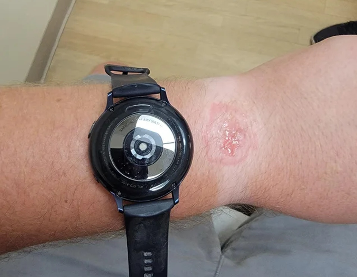 Zegarek Samsung poparzył użytkownika. Mnie też